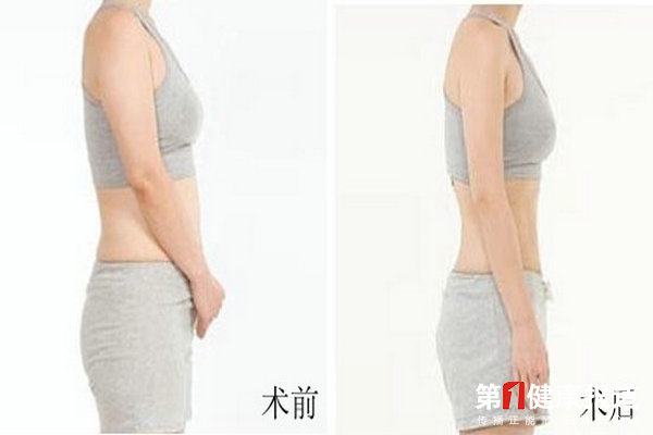 医美减肥减重 丁小邦谈手术吸脂