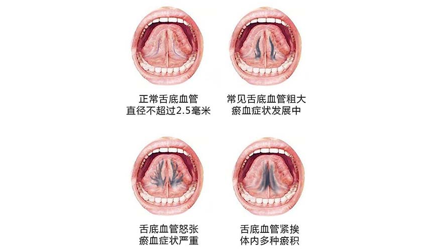 “舌下青筋”，可看身体状况！这种情况警惕→